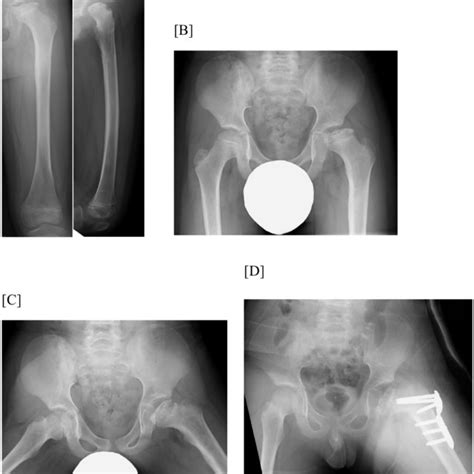 A Anteroposterior Ap And Lateral Radiographs Taken 18 Months