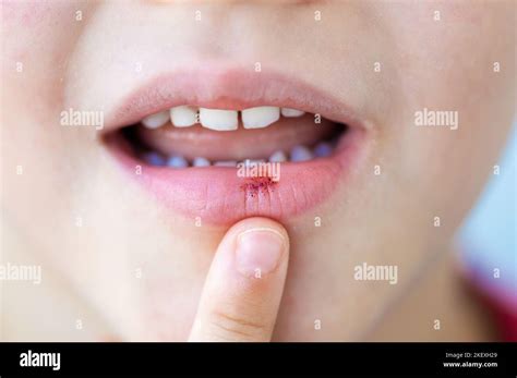 Aphthous Mouth Ulcer Hi Res Stock Photography And Images Alamy