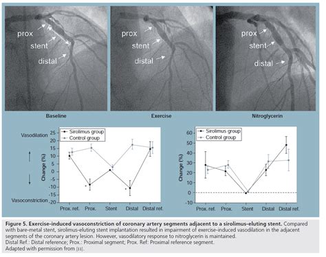 Effect Of Drug Eluting Stents On Endothelial Dysfunction
