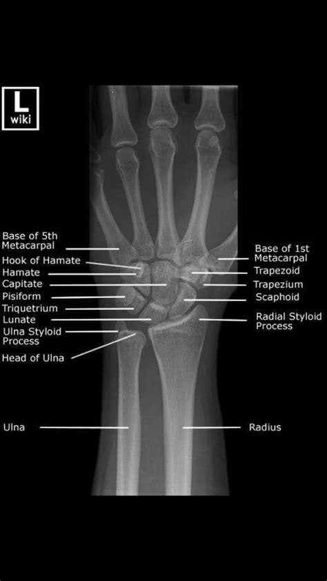 Bones Of The Hand And Wrist Medical Radiography Medical