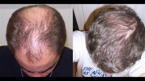 How To Treat Baldness Or Regrow Hair On Bald Spot Hair Loss In Women