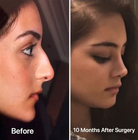 Pin On Rhinoplasty Before After 2020