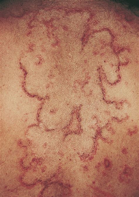Recurrent Annular Erythematous Scaly Patches Dermatology Jama