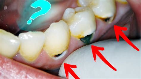 What S Hiding Inside These Dark Spots Dental Clinic