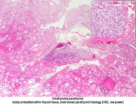 Pathology Outlines Parathyroid Tissue