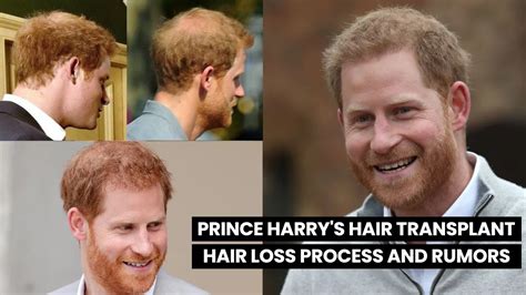 Prince Harrys Hair Transplant Hair Loss Process And Rumors Youtube