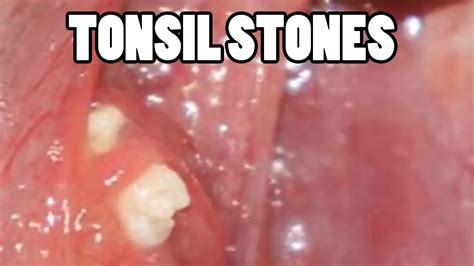 The Best Tonsil Stone Removal Video Youtube