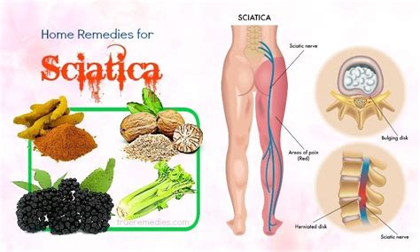 19 Natural Home Remedies For Sciatica Pain Relief