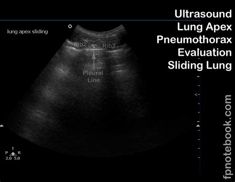 Lung Ultrasound For Pneumothorax