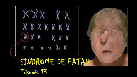 Top 134 Trisomia 13 Sindrome De Patau Imagenes Theplanetcomics Mx