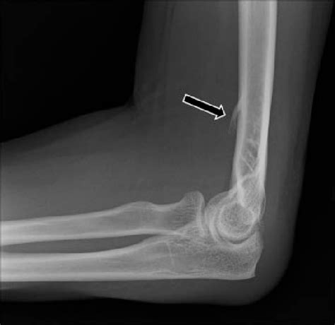 Normal Variant Of The Elbow The Supracondylar Process Or Avian Spur