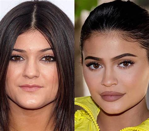 Kylie Jenner Before And After The Surgeries That Made Her A Billionaire