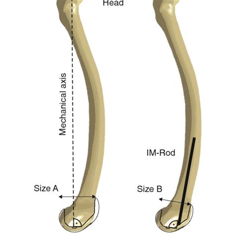 Mismatch Between Distal Anatomical And Mechanical Sagittal Femoral Axis