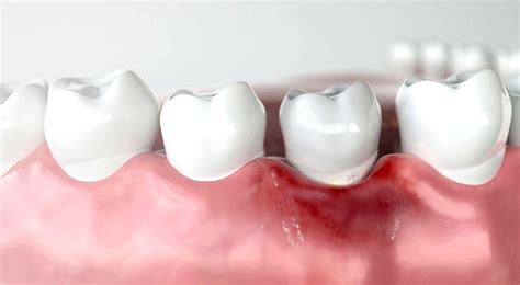 All You Need To Know About Gum Disease Directorio Odontológico
