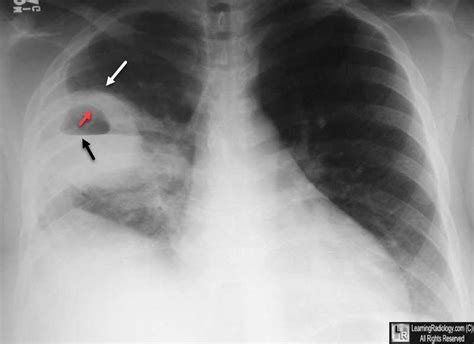 Learningradiology Lung Abscess Pulmonary