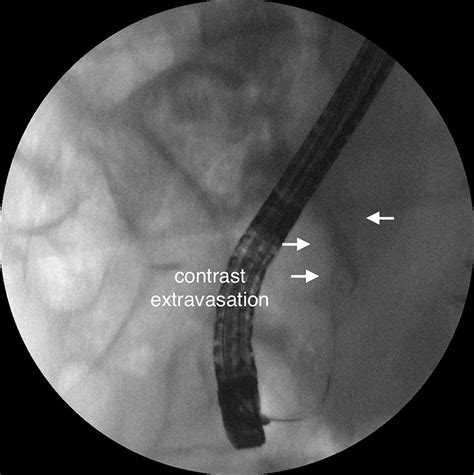 Common Bile Duct Intussusception During Ercp For Stone Removal Videogie