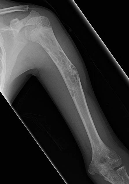 Rare Bone Tumor Fibrous Dysplasia Congenital Hand And Arm Differences