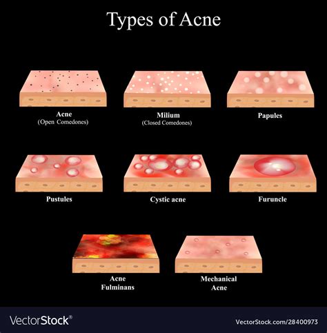 Types Acne Skin Inflammation Pimples Boils Vector Image