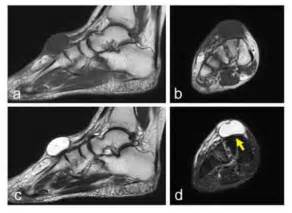 Persistent Symptoms Of Ganglion Cysts In The Dorsal Foot