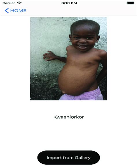 Malnutrition Detector Determining Kwashiorkor Disease Download