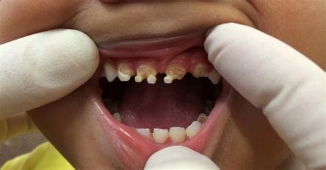 You Will Be Shocked By What Caused This Childs Massive Tooth Decay