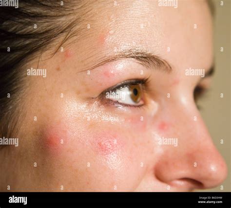 A Young Woman With Multiple Mosquito Bites Stock Photo Alamy