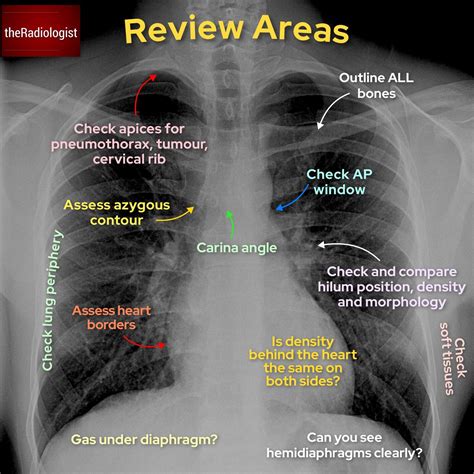 Normal Chest X Ray Labeled
