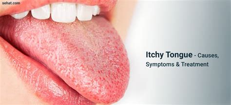 Itchy Tongue Causes Symptoms Remedies And Treatment