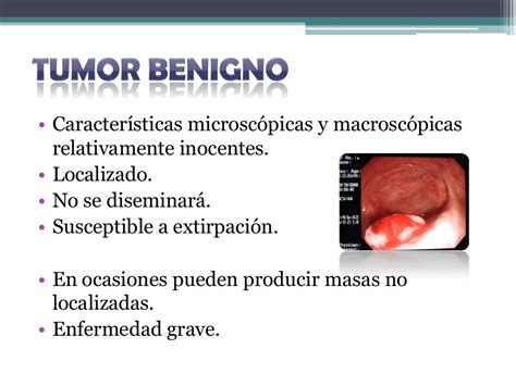 Característica Morfológica Do Tumor Benigno Condroma Ensino