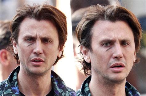 Ouch Jonathan Cheban Caught With Nasty Bruise Under His Eye
