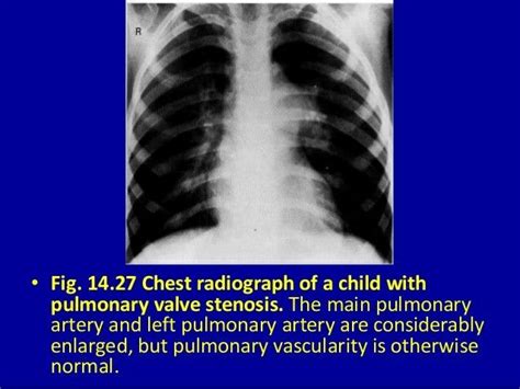 Note Pulmonary Vascularity Is Normal In A Pumonary Artert Valve