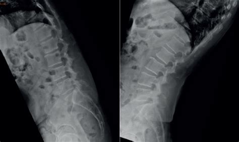 Bilateral Lumbar Facet Synovial Cysts As A Cause Of Radiculopathy