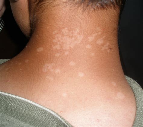 Tinea Versicolor China Pdf Ppt Case Reports Symptoms Treatment