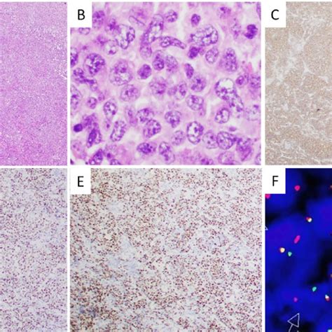 Pdf Large B Cell Lymphoma With Irf4 Rearrangement And Follicular