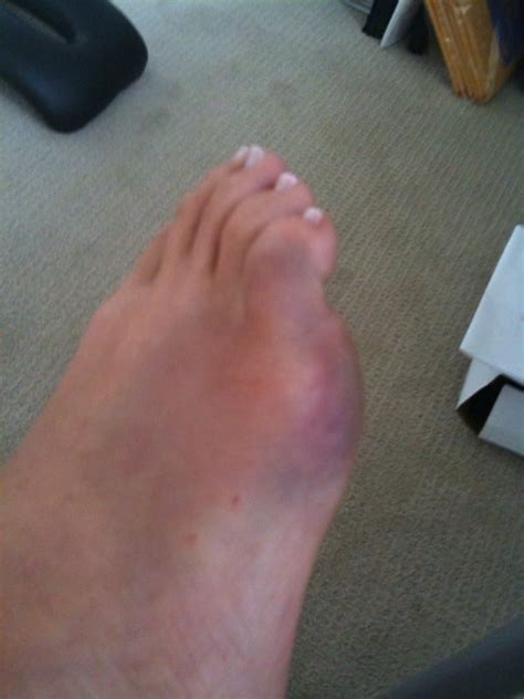 Unexplained Bruising On Feet And Toes
