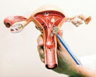 Endometrial kaviteye doğru büyümüş myomlardır. Myom des Uterus. Entfernen Auswirkungen auf den Körper