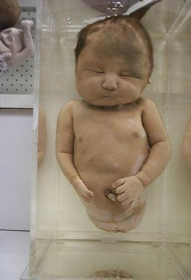 pin on radiation caused birth deformities