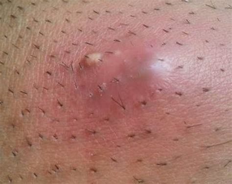 It is possible that you have ingrown hairs. Natural Acne Scar Treatment At Home Goods
