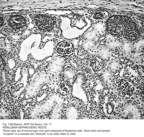 Pathology Outlines Nephroblastomatosis Nephrogenic Rests