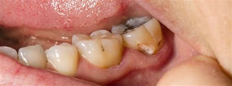 White Lines On Teeth Near Gums Toddler Teethwalls