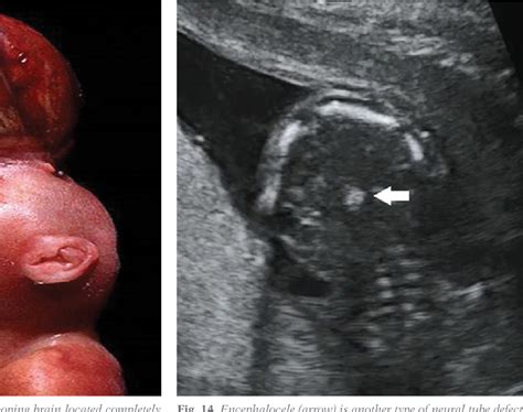 Figure 14 From Acrania Exencephaly Anencephaly Sequence Phenotypic