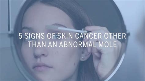 Moles Skin Cancer Warning Signs