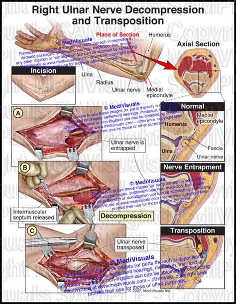 Right Ulnar Nerve Decompression And Transposition Medivisuals Inc