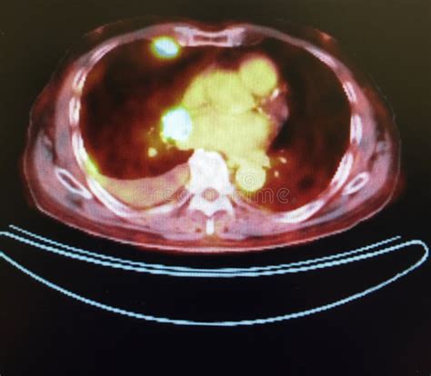 Pet Ct Tumor Mediastinum Penetrating Lung Frame Stock Photo Image Of
