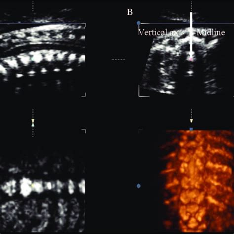 Multiplanar Display Of The Initial Three Dimensional Ultrasound Volume