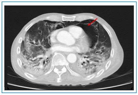 Scielo Brasil Rare Combination Of Pneumothorax Pneumomediastinum And Pneumopericardium And