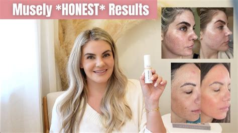Musely The Spot Cream Did It Work On My Melasma Youtube