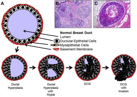 Breast Ductal Carcinoma In Situ The American Journal Of Pathology