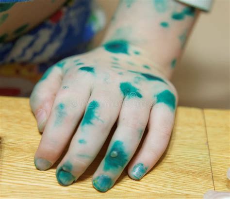 Photo Of The Child`s Hand Sick With Chickenpox Chuffed Blisters Are