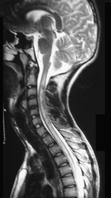 Glioblastoma Multiforme Of The Conus Medullaris With Holocordal Spread